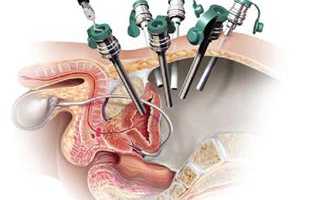 Лапароскопия предстательной железы: показания и отзывы