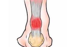 Лечение и причины бурсита ахиллова сухожилия