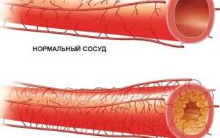 Синдром Ремхельда — все о симптомах и лечении патологии