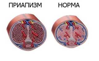 Причины, симптомы и лечение приапизма у мужчин