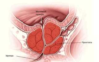 Опасность и последствия простатита