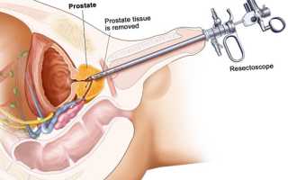 ТУР простаты: техника проведения и стоимость трансуретральной резекции простаты