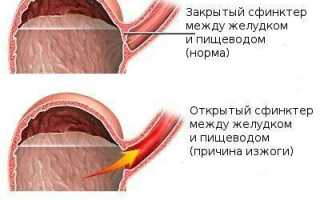 Недостаточность кардиального сфинктера желудка