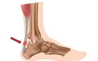 Воспаление ахиллова сухожилия