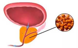Симптомы, причины и лечение калькулёзного простатита