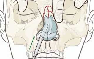 Перелом и репозиция костей носа