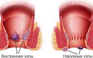 Причины и симптомы наружного геморроя
