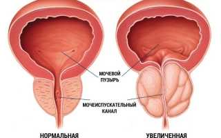 Хронический простатит: причины, симптомы, лечение и отзывы