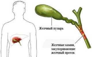 Знакомьтесь, одна из основных причин проведения экстренных операций – холецистит желчного пузыря