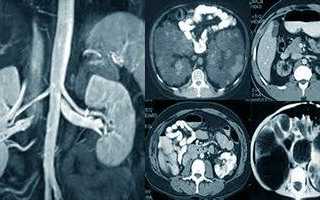 Исследование почек – что показывает МРТ, КТ
