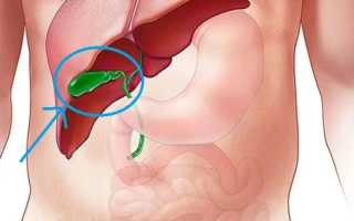 Как вывести желчь из организма: особенности застойных явлений и варианты лечения
