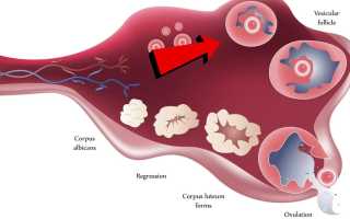 Киста жёлтого тела яичника – причины, симптомы, диагностика и лечение