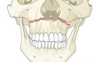 Признаки и лечение перелома верхней челюсти