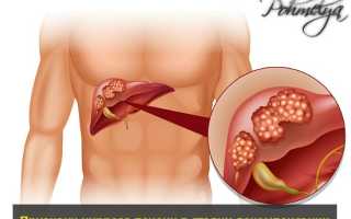 Признаки развития цирроза печени у мужчин от употребления алкоголя
