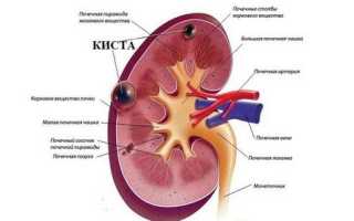 Киста на почке: нужна ли операция?