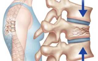 Компрессионный перелом позвоночника