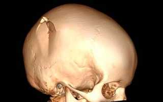 Симптомы и первая помощь при переломе черепа