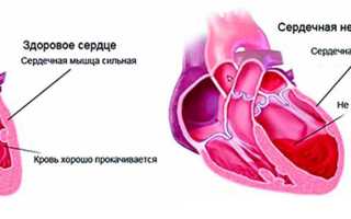 Что делать при острой сердечной недостаточности