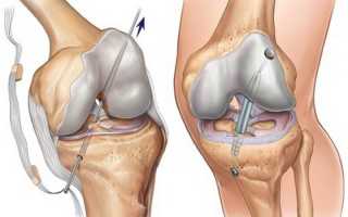 Восстановление связок коленного сустава