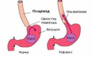 Как проявляется рефлюкс-эзофагит у детей и взрослых?