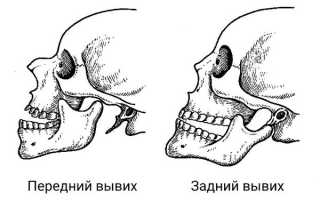 Первая помощь при вывихе нижней челюсти и лечение травмы