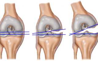 Все о разрыве связочного аппарата коленного сустава