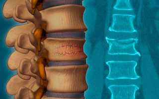 Симптомы и лечение декомпрессионного перелома позвоночника