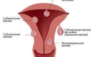 О чем говорят выделения при миоме матки и после ее лечения