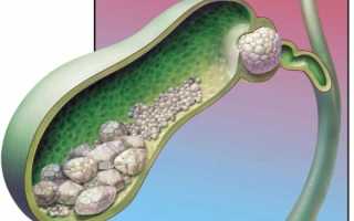Почему начинается желчекаменная болезнь