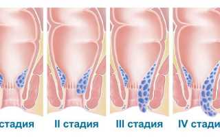 Оказание первой помощи при обострении геморроя