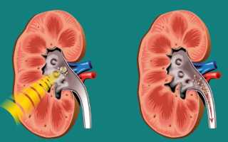 Особенности ультразвукового дробления почечных камней