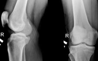 Повреждение связок колена: симптомы и лечение
