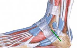 Надрыв связок голеностопного сустава