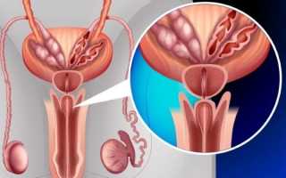 Симптомы и лечение абсцесса простаты