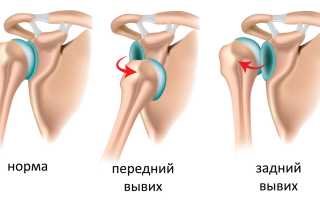 Вопрос-ответ про вывихи плечевого сустава