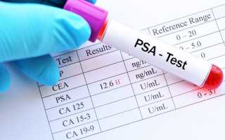 Онкомаркер ПСА общий и свободный: норма и расшифровка анализа при онкологии