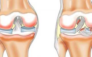 Разрыв латерального мениска коленного сустава
