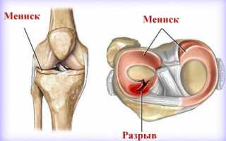 Виды повреждений мениска коленного сустава