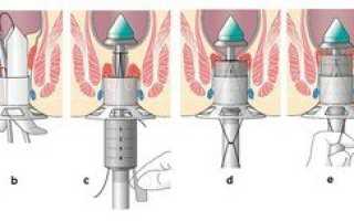 Оперативное лечение геморроя