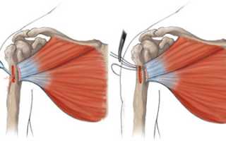 Повреждения грудных мышц