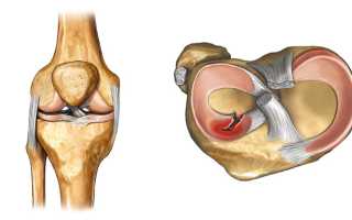 Симптомы и лечение разрыва заднего рога медиального мениска