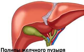 Удаление желчного пузыря: оперативные методики