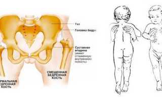 Врожденный вывих тазобедренного сустава