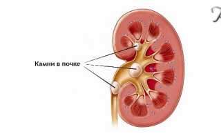 Можно ли пить пиво если есть камни в почках?