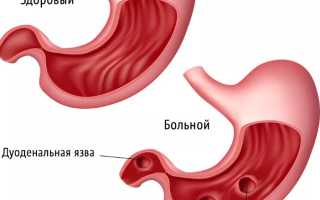 Как самостоятельно распознать возникновение перфорации желудка?