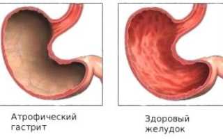 Как понять, что у вас развился атрофический гастрит? Чем опасно это заболевание?