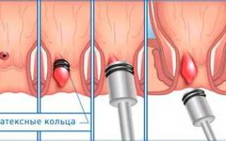 Как лечить шишки возле заднего прохода?