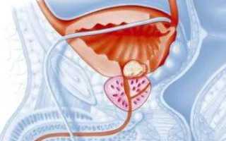 Причины, симптомы и лечение абактериального простатита