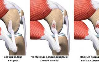 Симптомы и лечение надрыва коленных связок