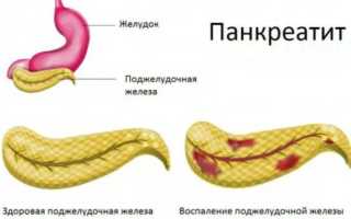 Симптомы приступа острого панкреатита